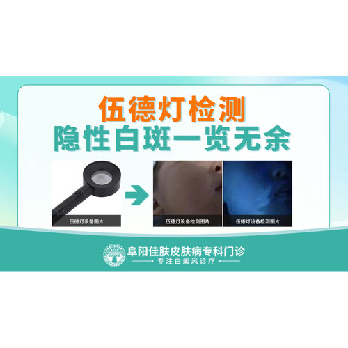 白癜风伍德灯检测
