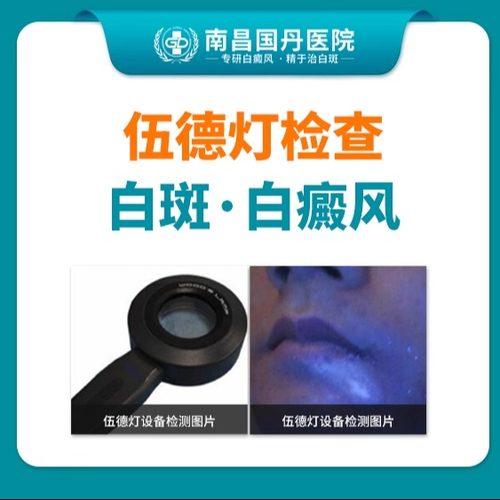 【热门产品】伍德灯仪器检查-白斑/白癜风