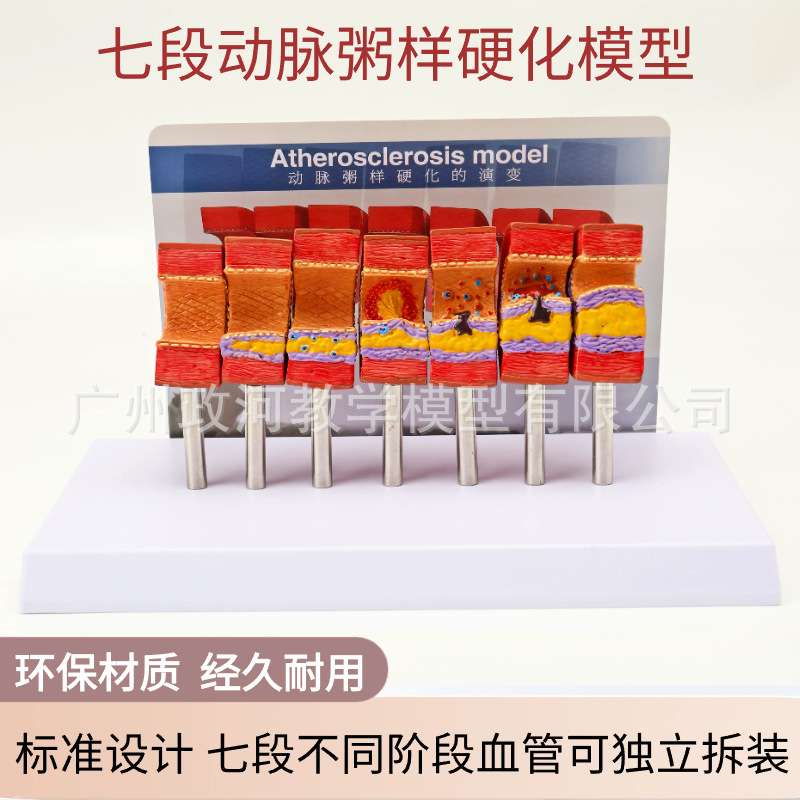 动脉病变硬化模型 动脉血管脂血管堵塞病态血管血管血栓栓塞模型