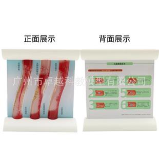 人体支脉粥血堵度塞863心管模型样血栓血液浓脂肪病理粥样硬化解