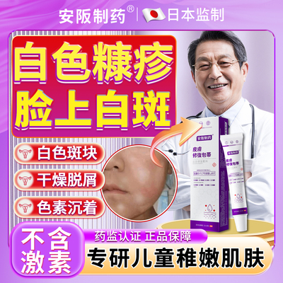 白色糠疹药膏儿童脸上长白斑小孩子汗斑花斑桃花癣干燥脱皮瘙痒KY
