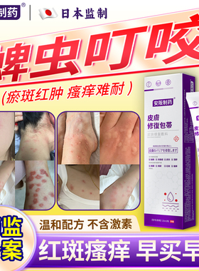 蜱虫叮咬瘙痒蚊虫虫咬皮炎过敏外用止痒消炎祛肿荨麻疹儿童药膏KY