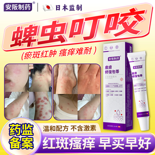 蜱虫叮咬瘙痒蚊虫虫咬皮炎过敏外用止痒消炎祛肿荨麻疹儿童药膏KJ