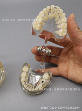 儿童病理模型 乳恒牙交替带龋坏蛀牙齿水晶透明牙齿模具 乳牙列