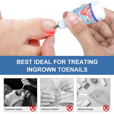 2pcs Toenail Fungus Antifungal Ingrown Fungus Toe Bacteria