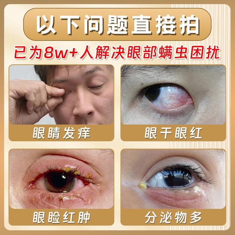 眼部除螨眼药水疗治眼睛去螨虫眼睑清洁眼角里面痒神器专用洗眼液