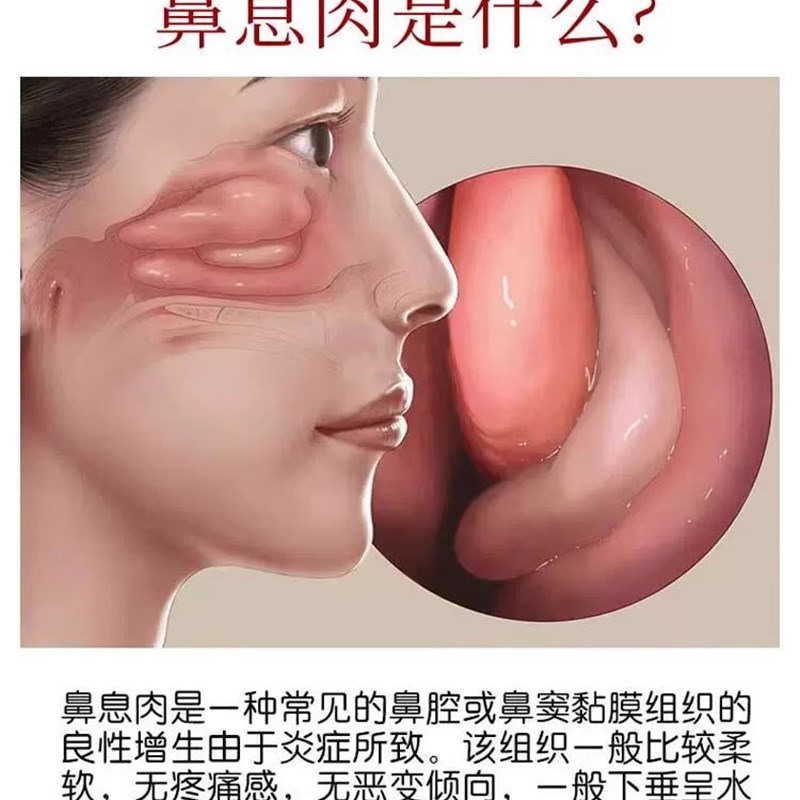 鼻息肉鼻窦炎鼻塞鼻甲肥大【不开刀自动脱落】鼻炎堵塞疏通鼻息