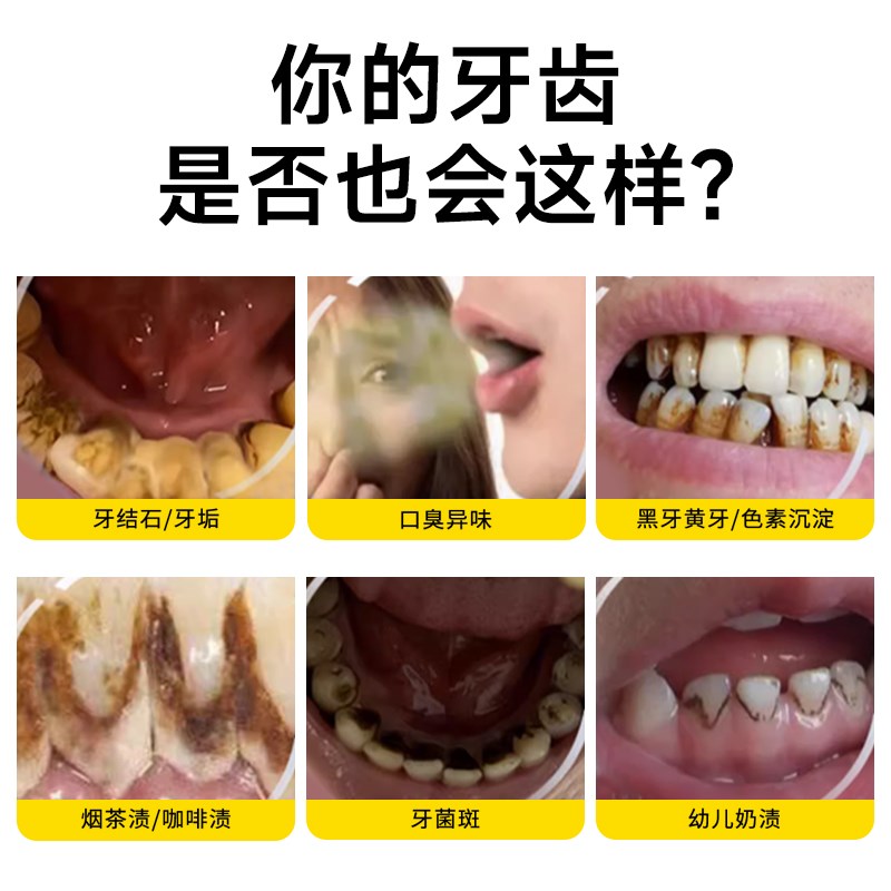 【C&M】超声波洗牙器冲牙结石去除神器洁牙仪牙齿污垢家用