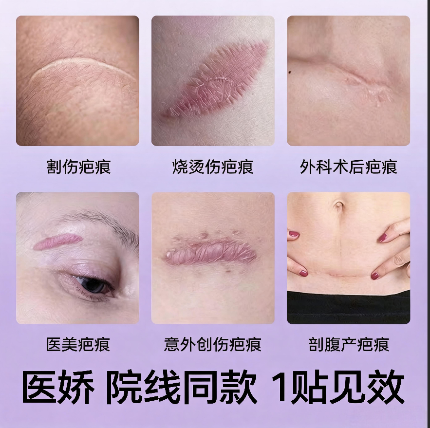 医娇硅凝胶剖腹产甲状腺医美术后