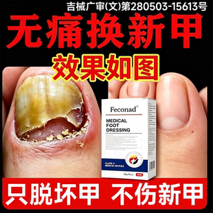 德国灰指甲专用正品抑菌灰甲液真菌冰醋酸 涂剂脚趾增厚医用变厚
