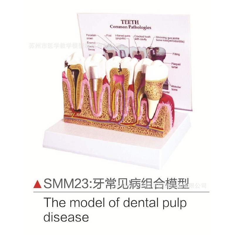 SMM23牙常见病组合模型,文具电教/文化用品/商务用品,教学标本/模型,淘宝优惠券,粉丝福利购,淘宝优惠卷