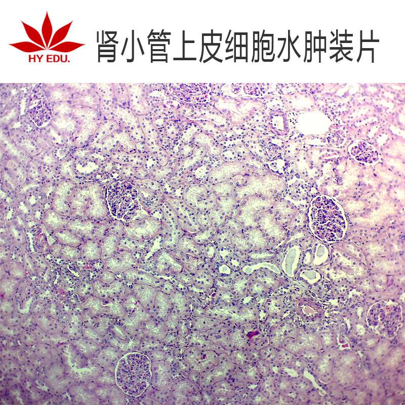 肾小管上皮细胞水肿生物切片 病理切片 成像清晰