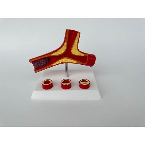 人体血管堵塞动支脉粥样硬化模型血管病理模型血栓演示教具