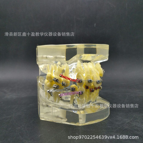 正畸模型 错颌矫正牙齿示范 牙列不齐拥挤缺失伸长展示 带支抗钉