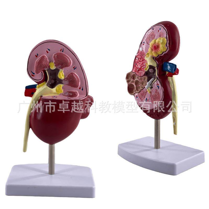 人体肾肾脏型肾解剖肾上腺放大模型877病变脏人体内脏器官解模附,文具电教/文化用品/商务用品,教学标本/模型,淘宝优惠券,粉丝福利购,淘宝优惠卷