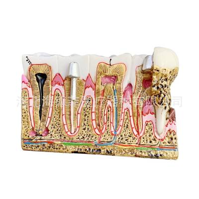 M4029病理牙齿模型右下后牙组织分解模型