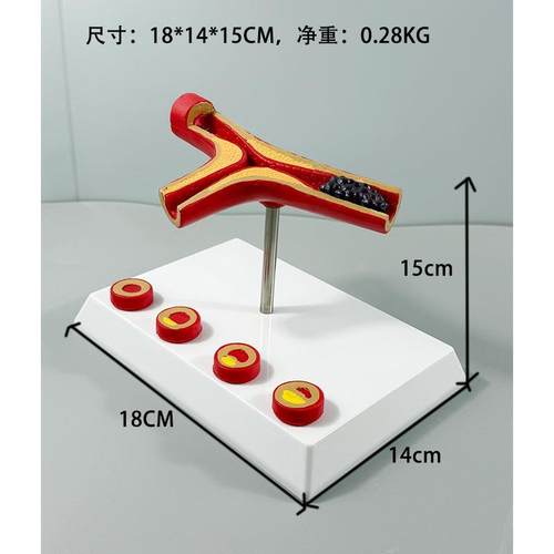 人体解病477剖血管堵塞模型液浓度血脂肪病血液血管粥理样血管理