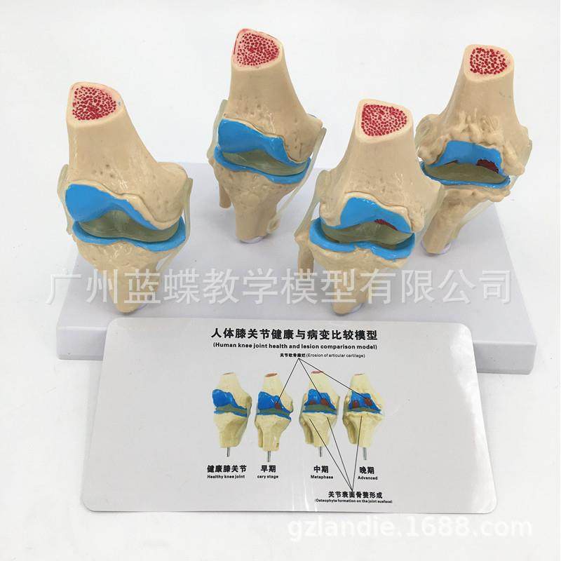 膝关节-病理600模型关节骨质-病态型展示人体膝带关节-病变模说明,文具电教/文化用品/商务用品,教学标本/模型,淘宝优惠券,粉丝福利购,淘宝优惠卷