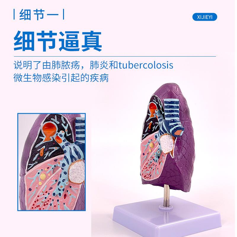 人体气管844肺肺剖病理肺模型吸烟者肺切面内解系科和呼吸统模型