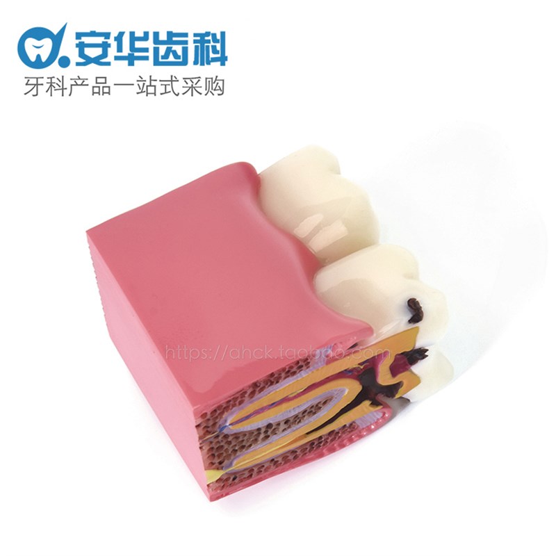 牙齿模型6倍龋齿对比模型 蛀牙演示模型剖面模型医患沟通教学模型