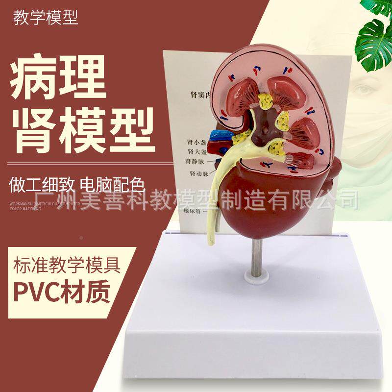 剖医学人体肾771脏解模型病肾部模型病态脏泌肾尿外科男科理专科