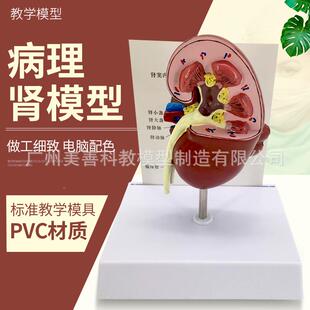剖医学人体肾771脏解模型病肾部模型病态脏泌肾尿外科男科理专科