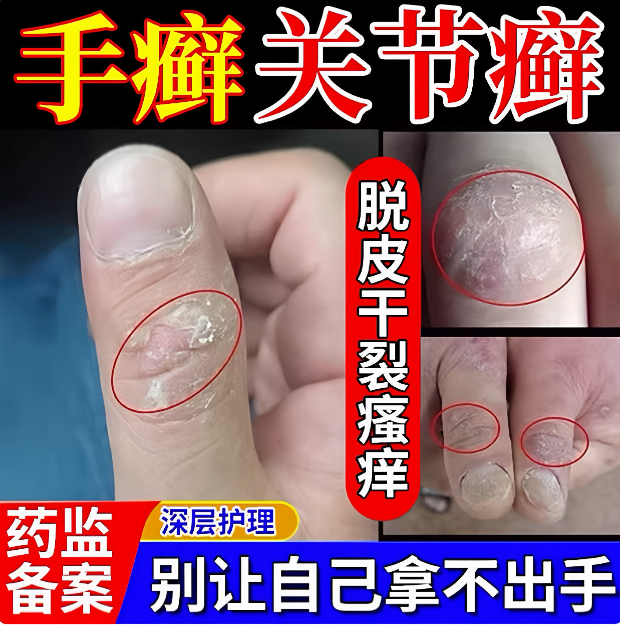 手指关节癣手癣膏脱皮干裂真菌感染鹅掌风手藓湿疹止痒手足癣药HQ