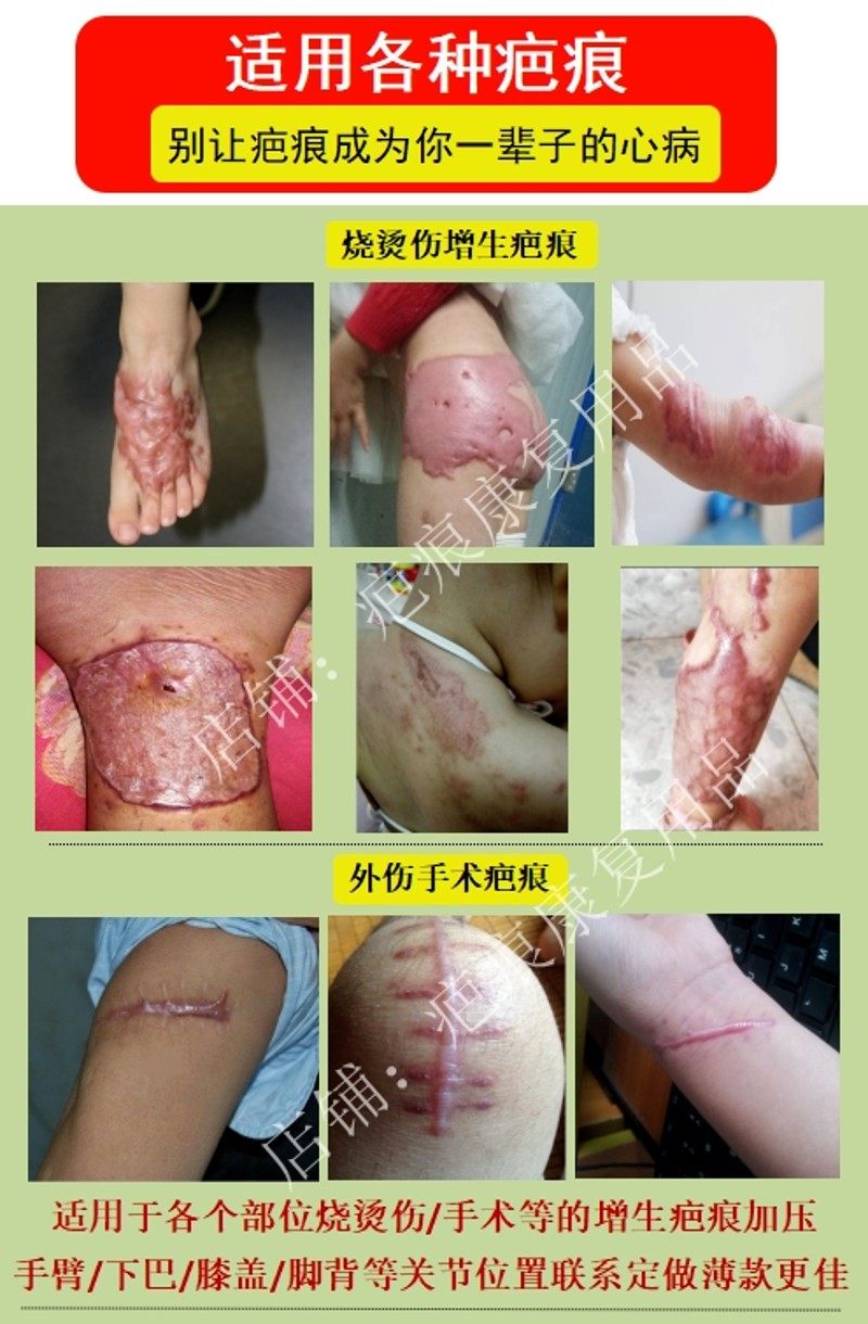疤痕增生加压垫压力垫去疤痕贴疤痕硅胶垫烧伤烫伤弹力套疤痕修复