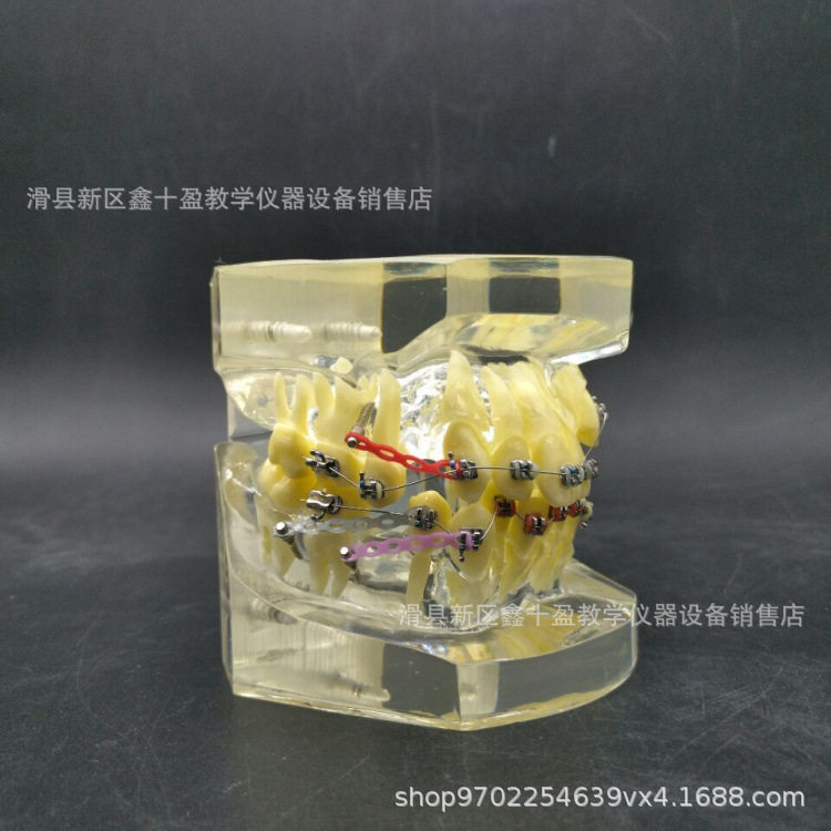 正畸模型 错颌矫正牙齿示范 牙列不齐拥挤缺失伸长展示 带支抗钉