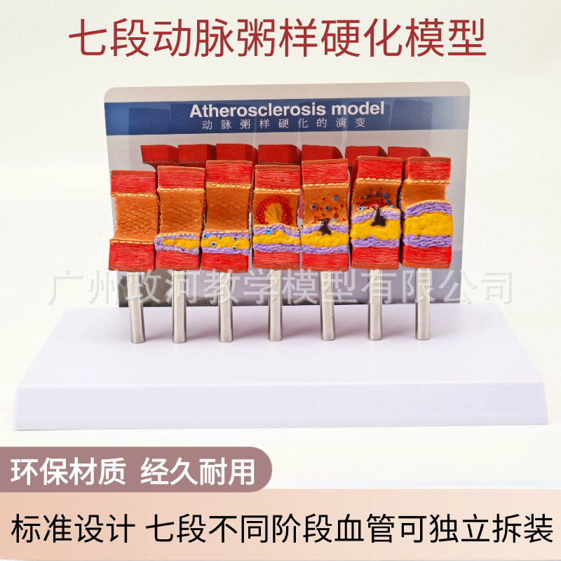 动脉病变硬化模型 动脉血管脂血管堵塞病态血管血管血栓栓塞模型