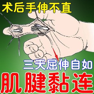 【术后恢复】手指肌腱黏连手伸不直手指发麻弯曲无力疼痛腱鞘//炎