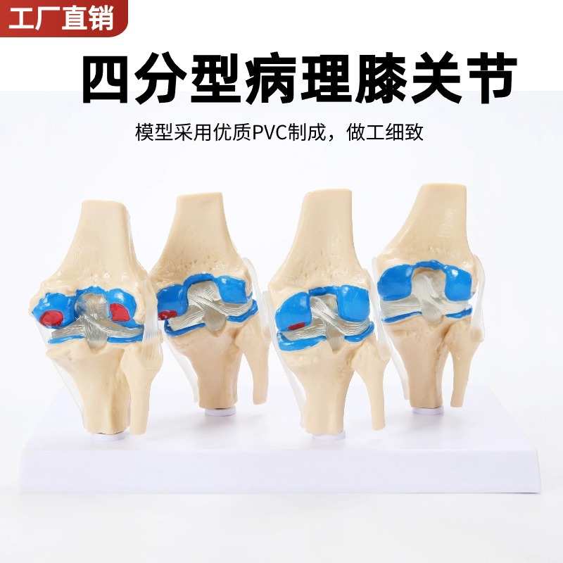 四分型膝关节正常与膝盖骨病变组合模型 人骨架模型 人体模型