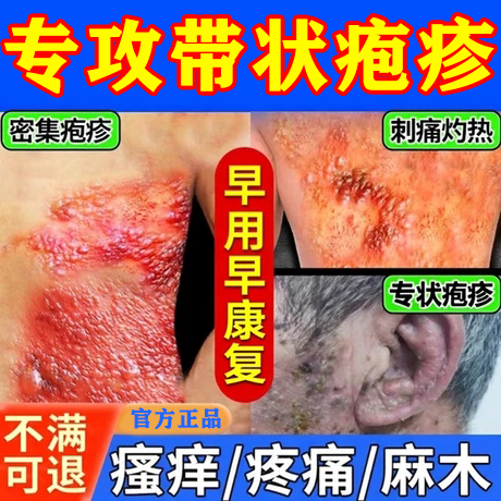 带状疱疹后遗症神经痛外用刺痛蛇盘疮治专用特膏药效喷剂瘙痒根