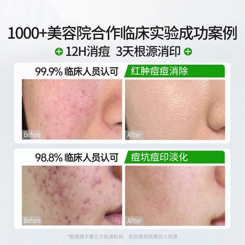 积雪草苷霜官方正品复颜软舒缓乳霜红软膏消淡化痘印EFB黑膏色素