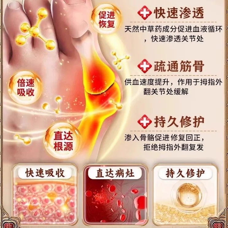 拇ZTI指外翻药专用大突脚膏趾骨外翻指出矫正器拇囊炎防磨拇外翻