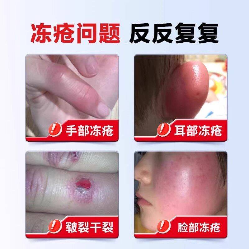 冰鳄油冻疮膏消正品非止痒防冻裂非治冻手MGX裂冬天鳄王鱼冻伤膏