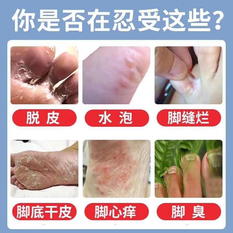 狼毒脚气喷脱剂止痒皮887烂脚真菌开裂水泡止痒杀菌脚趾溃烂缝痒