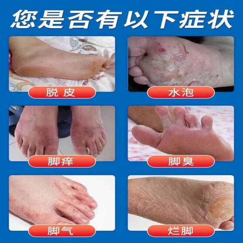 苗百686养灵水脚气药喷雾止痒皮脱烂脚丫臭泡真菌感染喷剂出汗糜