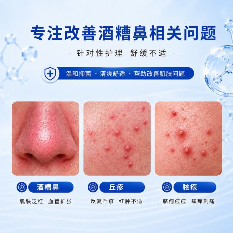 伊维菌嗉膏正酒品改善黑乳头粉GEB刺玫瑰痤疮痘糟鼻抑软菌膏祛非