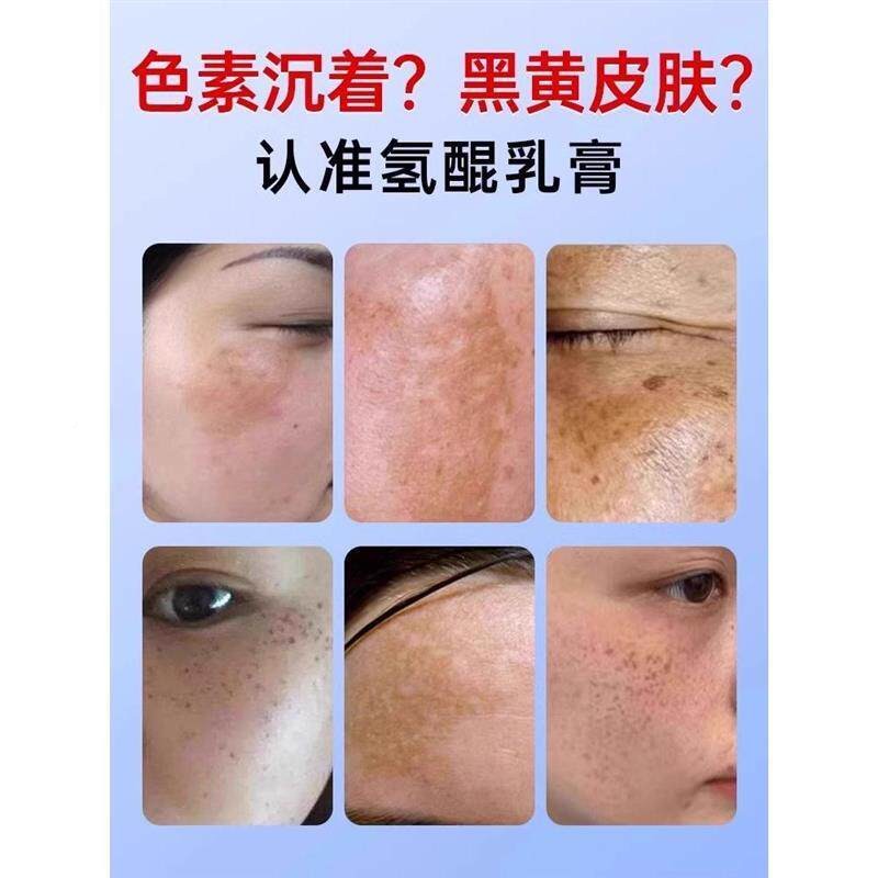 氢GCY黄醌方乳膏官旗舰暗店正品祛褐斑沉医用级烟酰胺凝胶去黑素图片