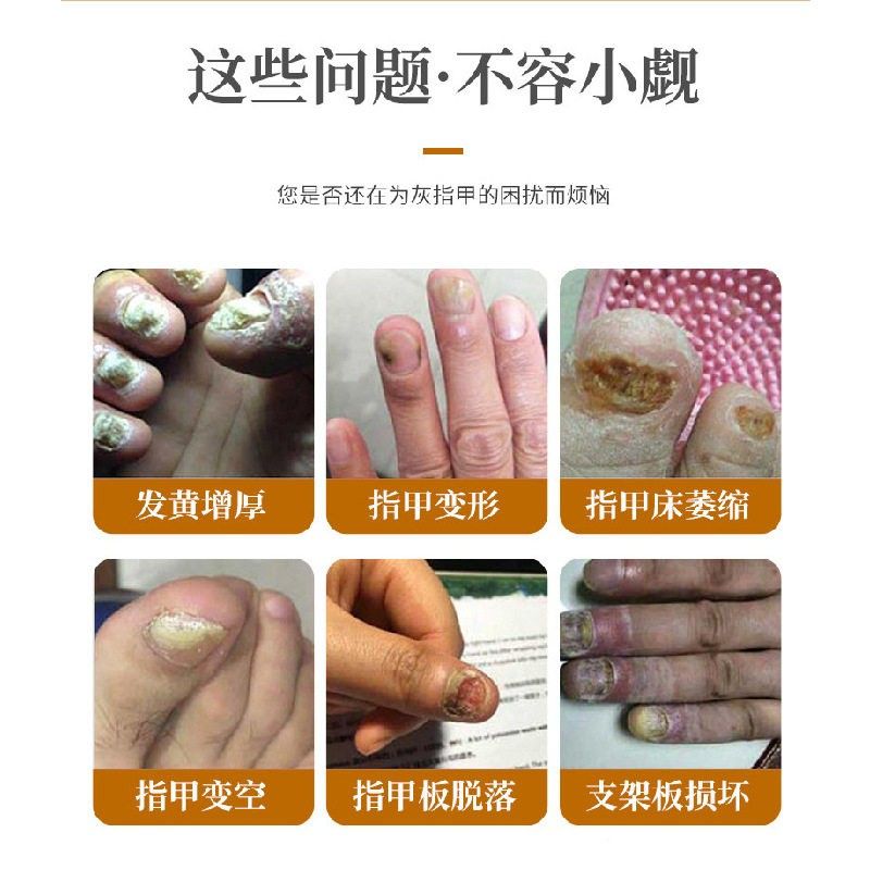 正品 泰甲康灵灰甲理UKG液坏甲空甲增护林厚正发黄甲沟抑菌亮甲