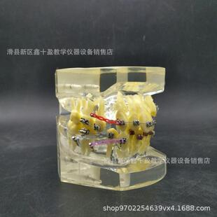 正畸模型 错颌矫正牙齿示范 牙列不齐拥挤缺失伸长展示 带支抗钉