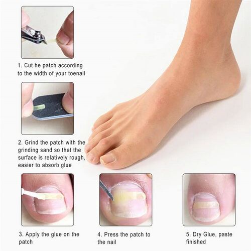 10-100PCS/Bottle Ingrown Toenail Correction Tool Ingrown Toe