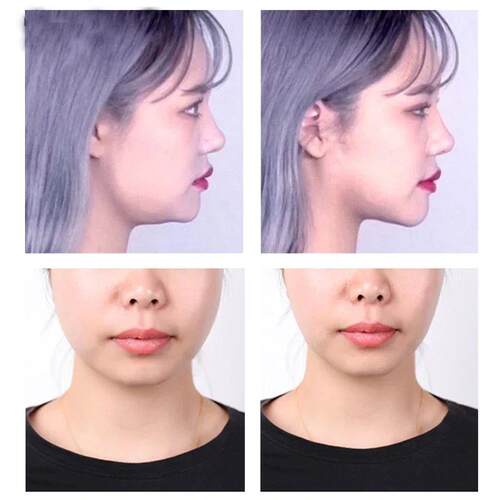 40-120PCS V-Shape Face Wrinkle Sagging Skin Adhesive Tape Li
