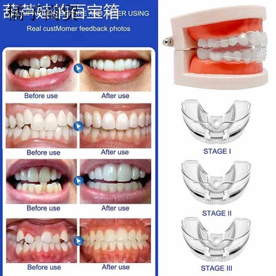 Dental Braces for Teeth Straightener Orthodontic Appliance B