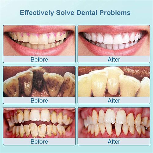 Sonic Teeth Tartar Plaque Cleaner Dental Stone Removal洁牙器