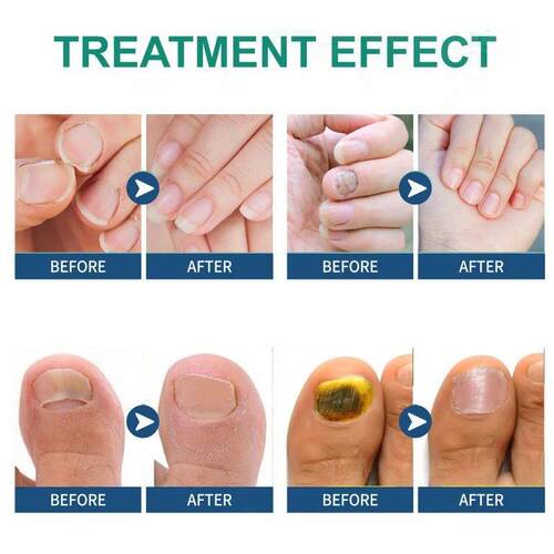 Fungal Nail atment Patch Anti Infection Paronychia Thickenin