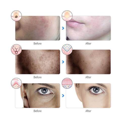7 Colors Photon Facial LED Mask Red Light Therapy Anti Aging