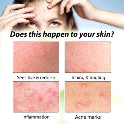 Hoygi Herbal Acne Essence deeply hydrates, balances oil, and