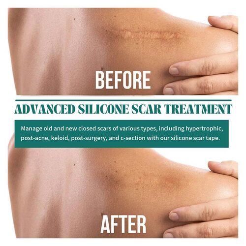 Scar Sheet Scar Silicone Strip Scar Tape Roll